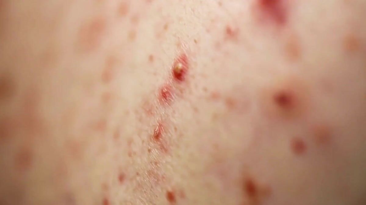 Advanced Acne Class 2 | crossan skincare